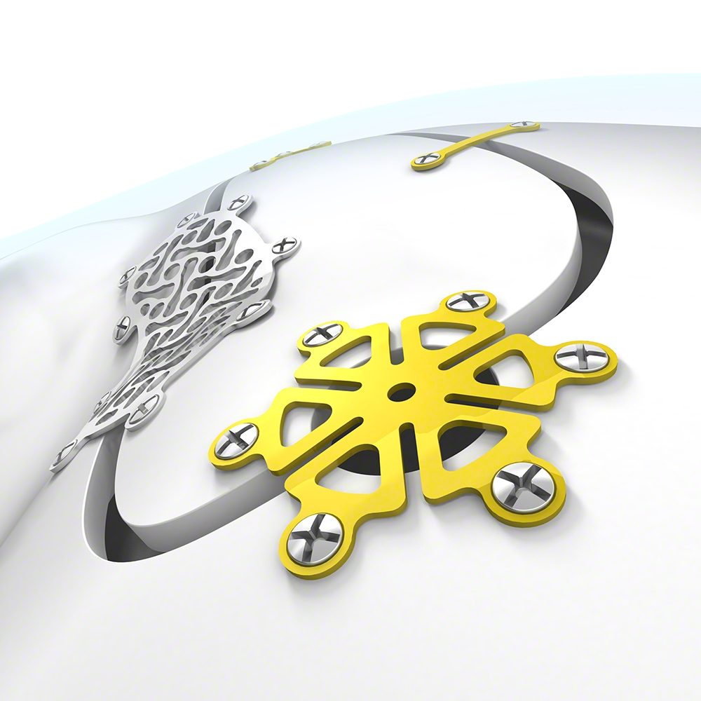 Neuro Plating System1 Neuro-Plating-System supplies Cameroon