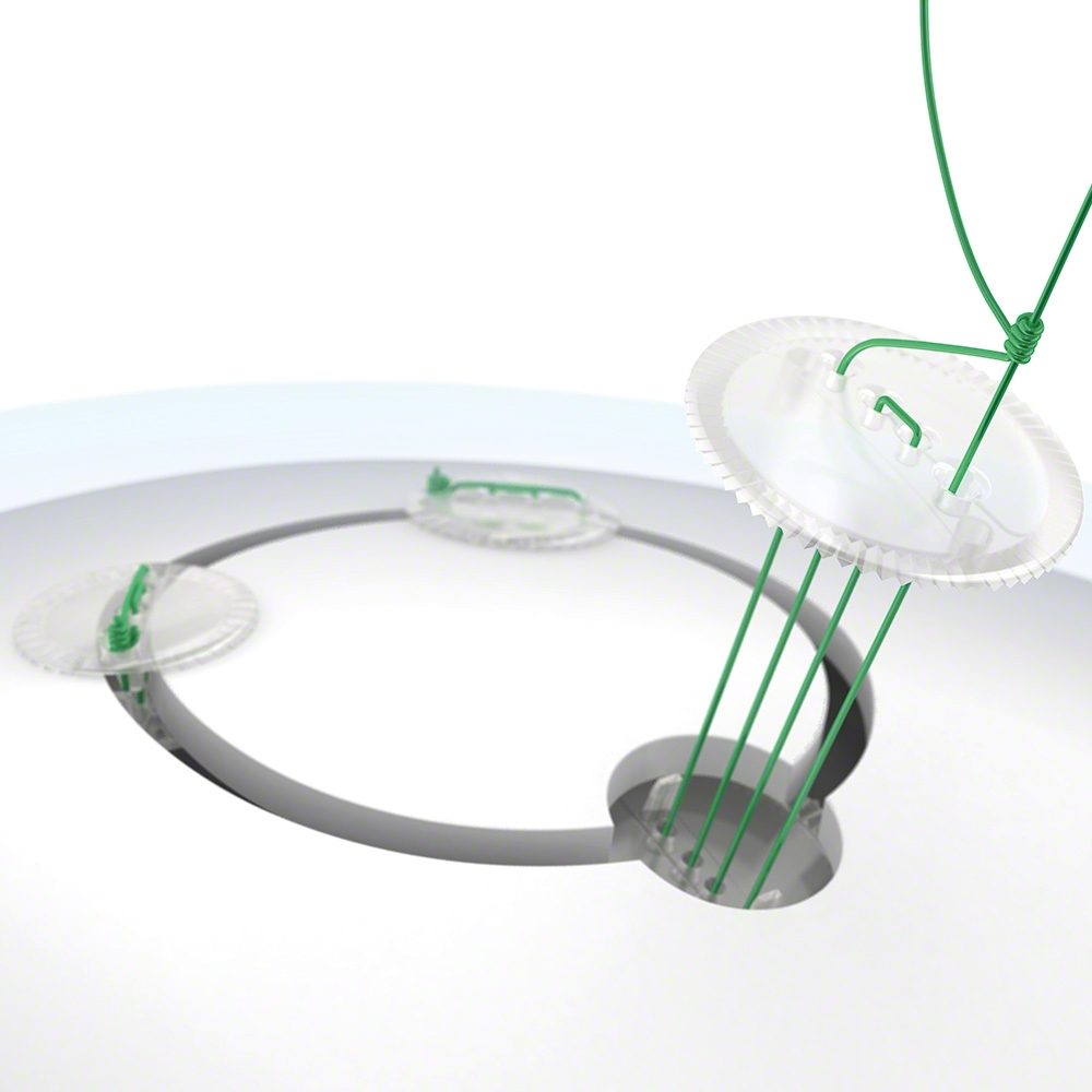 Neuro Plating System2 Neuro-Plating-System supplies Cameroon