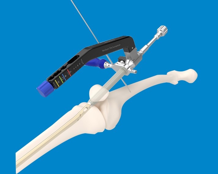 NEOSUPRA tibial nail system supplies Cameroon5 NEOSUPRA tibial nail system supplies Cameroon